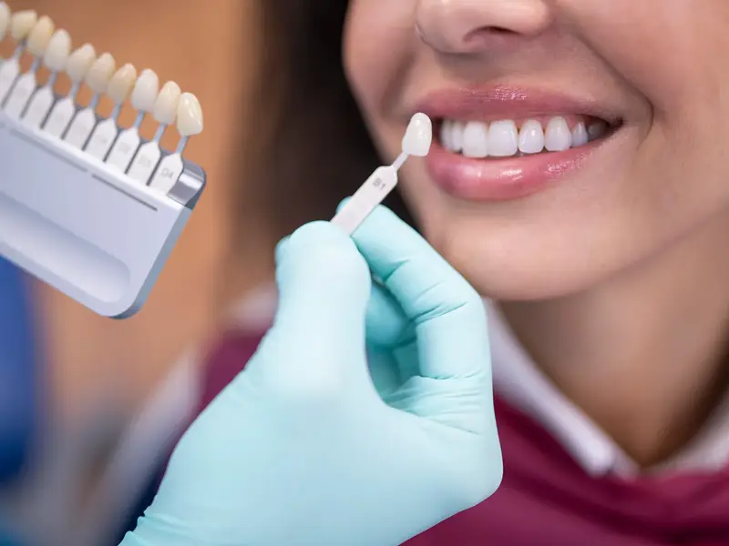 Dentist holding veneer to patient's tooth