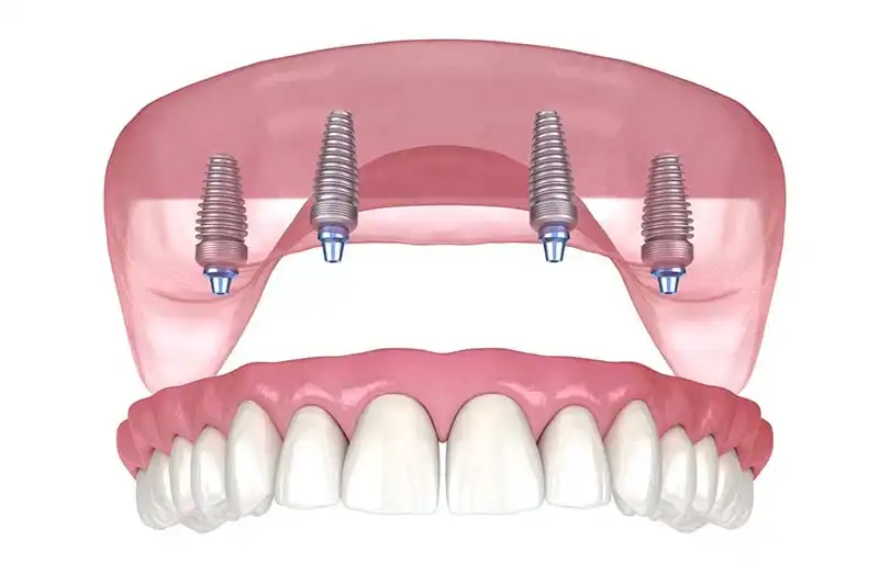 All on X dental implants