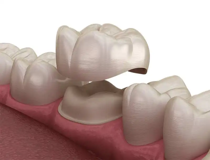 Dental crowns
