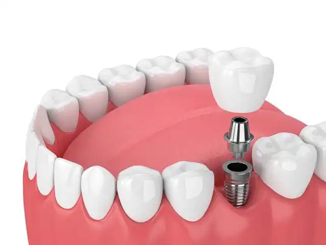Dental implants